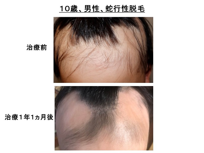 円形脱毛症　病院